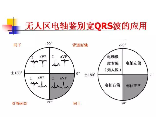 幻灯精粹 郭继鸿|宽qrs波心动过速的鉴别  北京大学人民医院主任医师