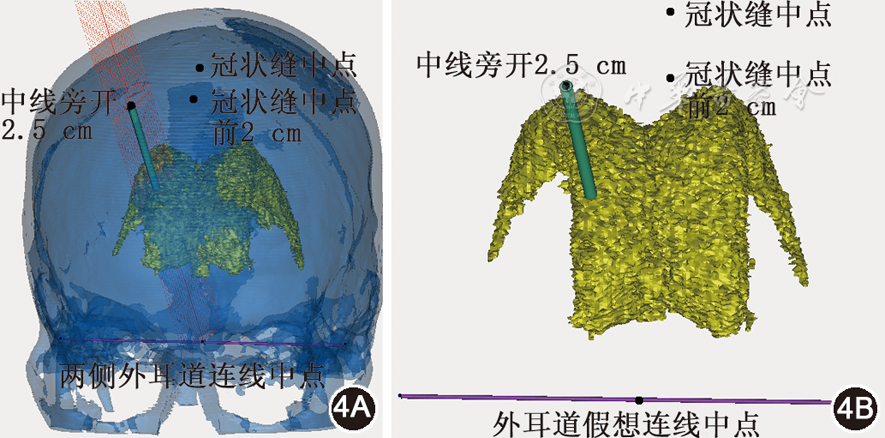 计算机三维重建技术下模拟侧脑室额角穿刺方法的 ...